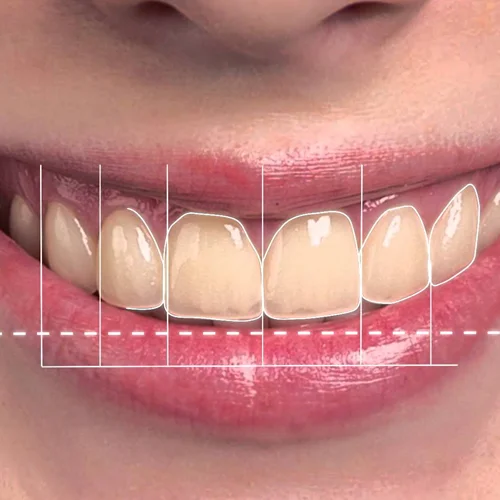 Smile-makeover-1