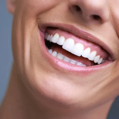 Smile-makeover-2